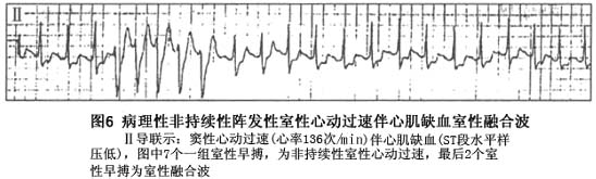 阵发性室性心动过速