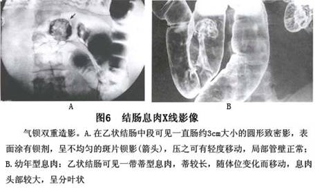 结肠息肉和息肉病