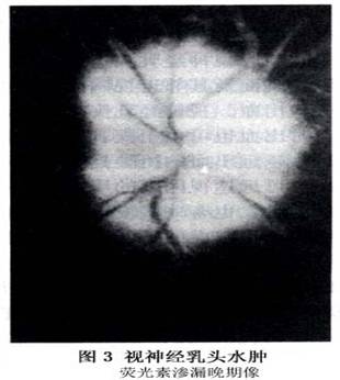 视神经乳头水肿及视盘水肿详情