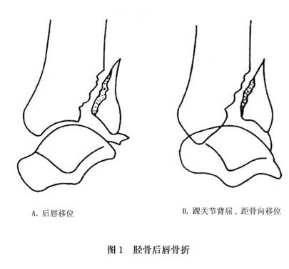 如果诊断胫骨后唇骨折而未发现内踝或外踝损伤,应注意伴随的软组织