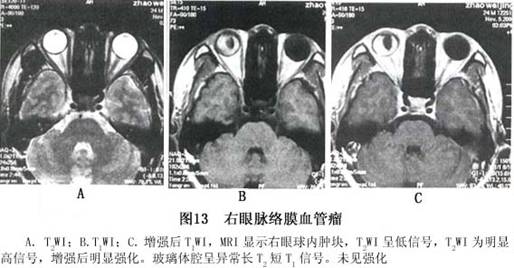 脉络膜黑色素瘤