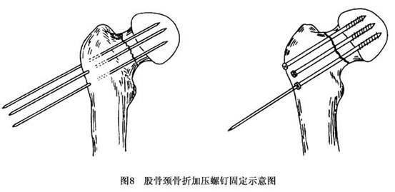 股骨颈骨折