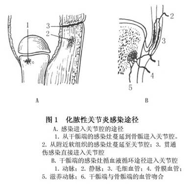 化脓性关节炎