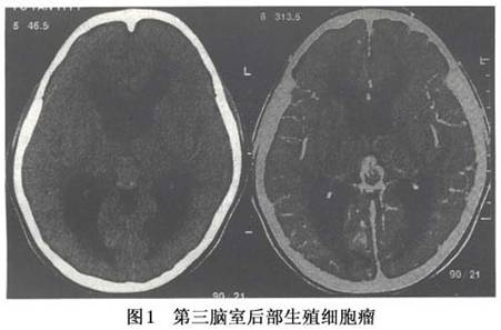 脑内生殖细胞瘤