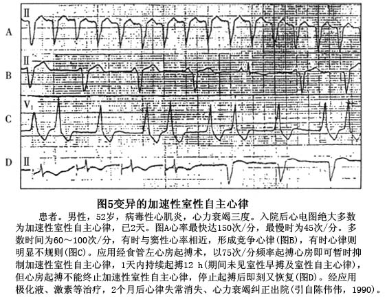 加速性室性自主心律