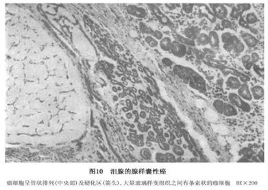 圆柱瘤/囊性腺样癌/圆柱瘤型腺癌-疾病概述-疾病专区-微医(挂号网)