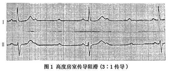 高度房室传导阻滞