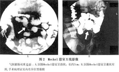 麦克尔憩室