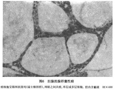 圆柱瘤