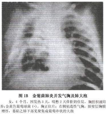 小儿金黄色葡萄球菌肺炎