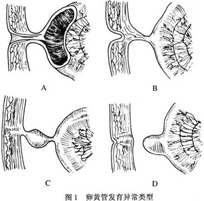 由于卵黄管退化过程中所受障碍的部位,程度不同,憩室的形态和病理改变