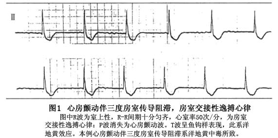 心室率40～60次/min(图1)或室性逸搏心律(qrs宽大畸形),心室