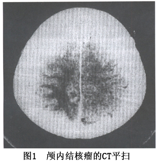 脑结核瘤