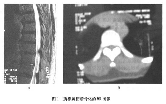 胸椎黄韧带骨化症