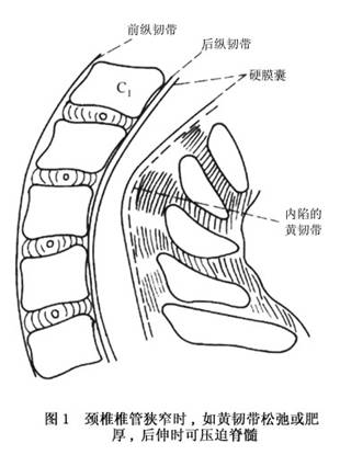 颈椎椎管狭窄症