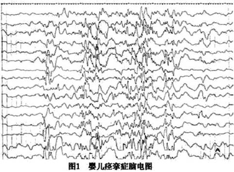 继发性癫痫