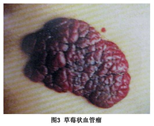 草莓状血管瘤 草莓状血管瘤(strawberry hemangioma)又称毛细血管瘤