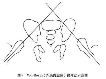 1.von-rosen(外展内旋位)摄片法(图5)