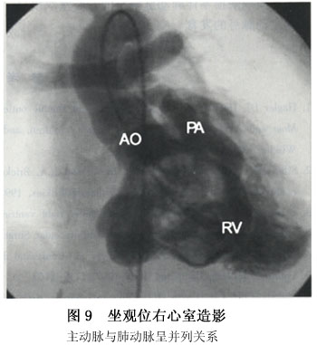 小儿右室双出口