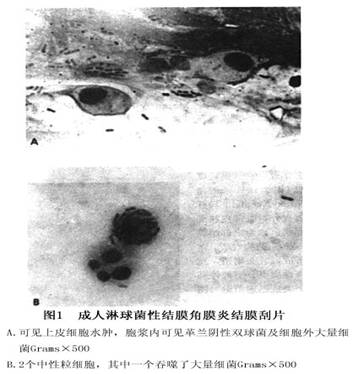 淋球菌性结膜炎