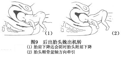 疾病百科 疾病介绍      (1)臀位的阴道分娩机转:     ①胎臀的娩出