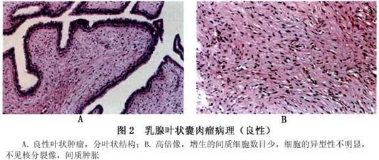 乳腺叶状肿瘤