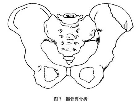 骨盆骨折