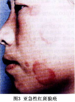 scle的皮损最初表现为丘疹或红斑,可发展为带鳞屑的丘疹或环形(多