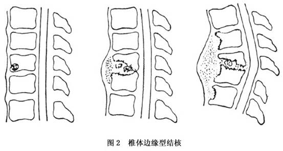 脊柱结核