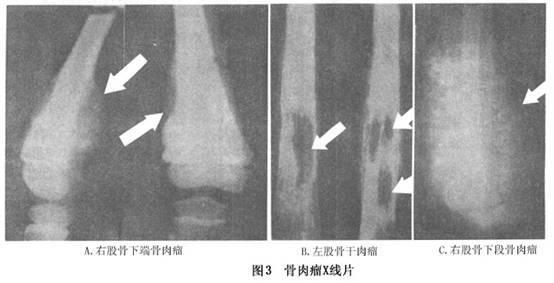 x线检查 x线表现,包括以下3个方面①原来的骨皮质和髓腔的破坏,即骨