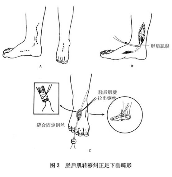 6cm之s形切口(图3a),切开皮肤,皮下组织及深筋膜,显露及游离胫后肌腱