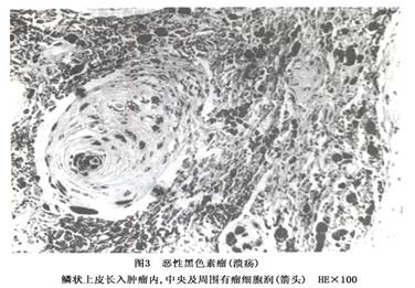 疾病介绍     来源于痣的恶性黑色素瘤,对恶性黑色素瘤标本作连续切片