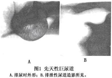 先天性巨尿道症