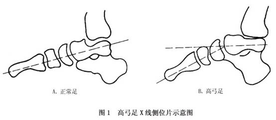 x线表现,站立时摄足的x线侧位片,高弓足畸形的表现最为典型.