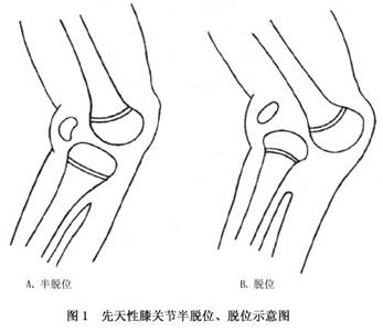 先天性膝关节脱位