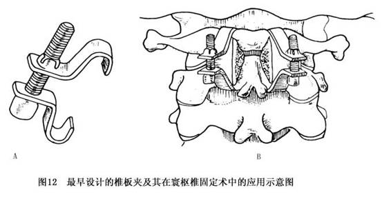 单纯性寰枢椎脱位详情