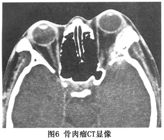 眼眶骨肉瘤详情