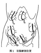 如中肠旋转不全,阑尾位置可随盲肠位置异常而改变(图2).