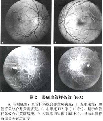 眼底血管样条纹