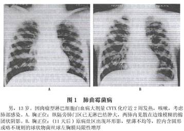 小儿真菌性肺炎