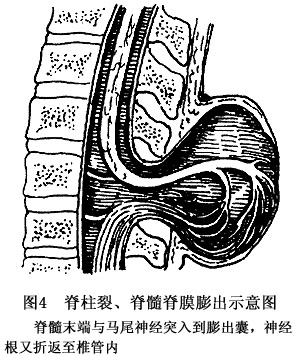 脊膜膨出与脊膜脊髓膨出