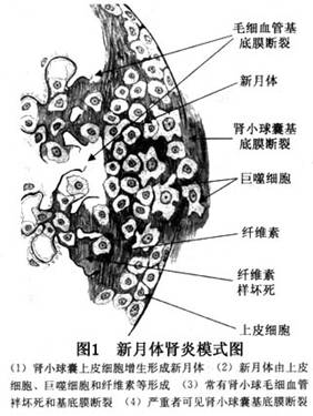 有时还可见igg沿肾小管基底膜沉积.