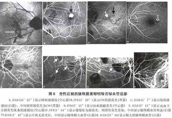 变性近视的脉络膜萎缩