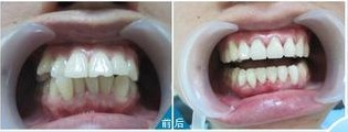 直丝弓自锁矫治: 针对亚洲人牙齿矫正特效技术