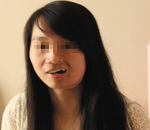 上海半侧颜面萎缩修复哪家医院好