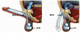 使用时,按动阴囊内圆形膨胀开关按钮,储液囊中的液体立即充入