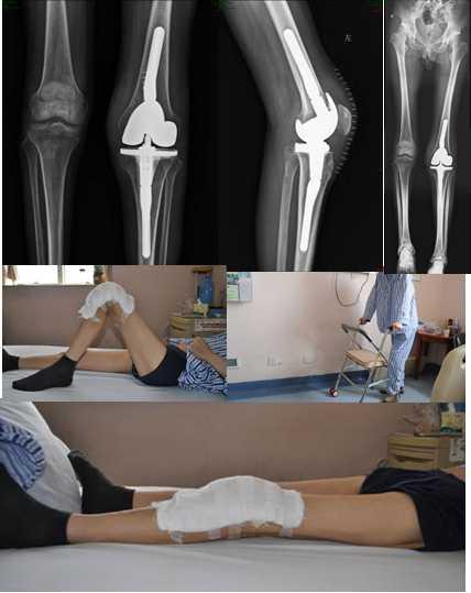术前患者严重膝关节畸形,屈曲挛缩30°,完全不能伸直,更无法下床行走.