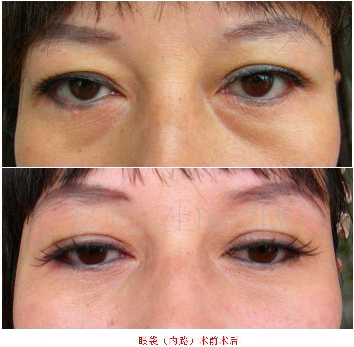 内切眼袋术前术后
