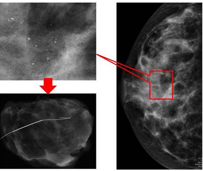 乳腺癌改良根治术切口范围示意图 早期的乳腺隐匿性钙化灶的发现