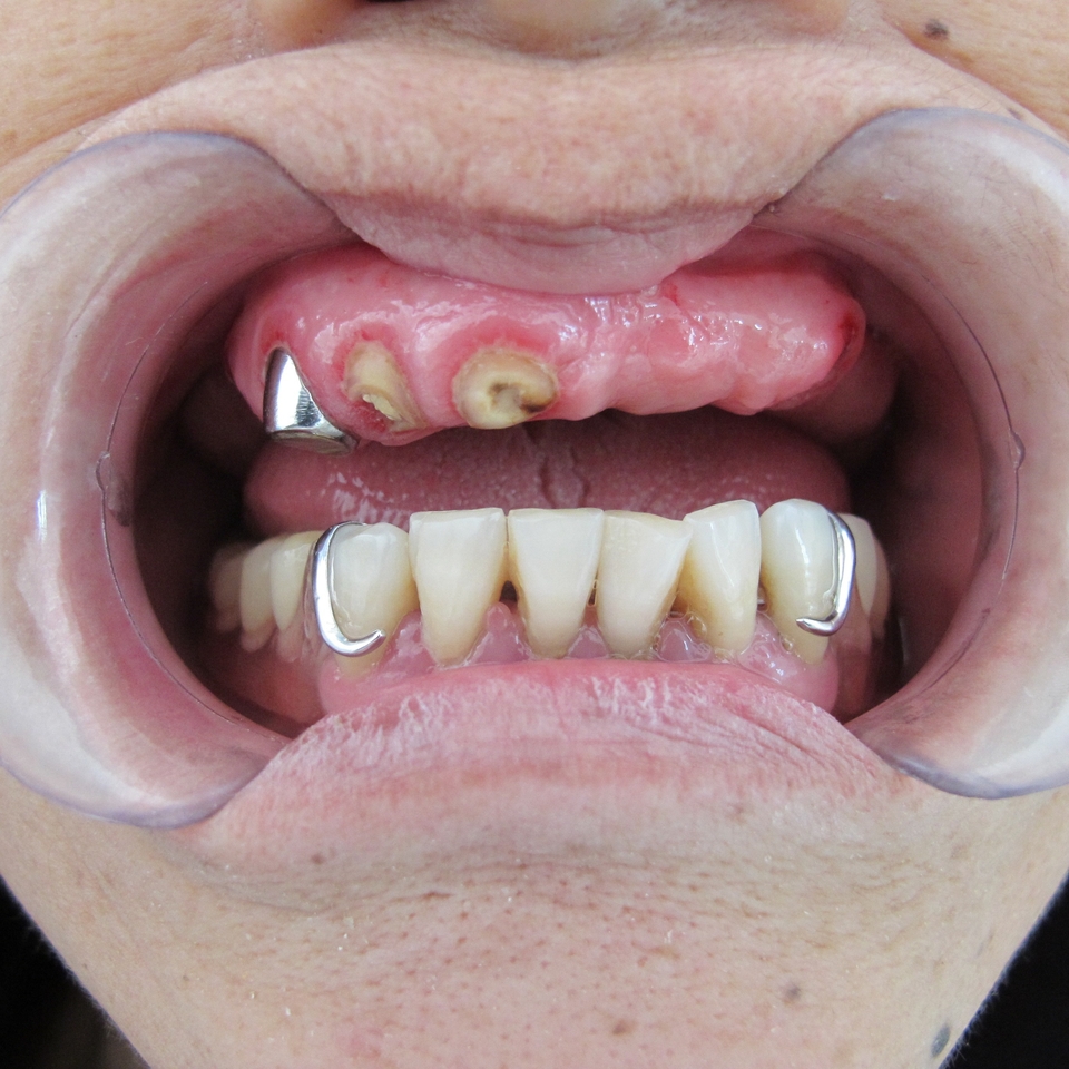 半口牙缺失怎样修复
